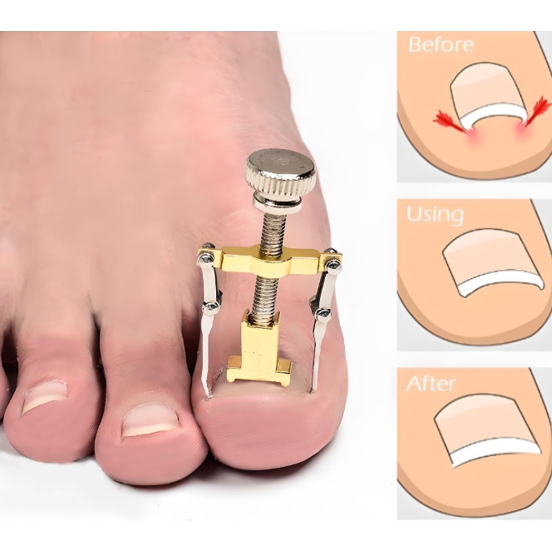 Ingrown Toenail Corrector Clamp  Professional Relief & Nail Reshaping Tool x1